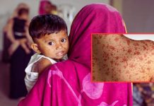 একদিনে হাম ও উপসর্গ নিয়ে ৭ শিশুর মৃত্যু